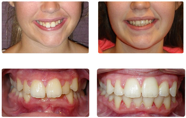 Invisalign Spaced Teeth Before And After Teethwalls 