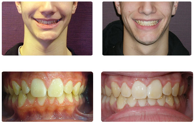 Teen Invisalign and Braces - Before and After